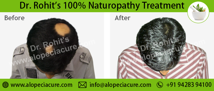 hair loss treatment